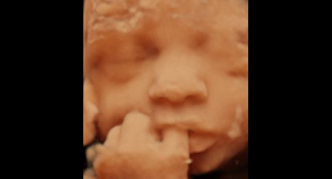 Bébé suce son pouce — 32 SA
